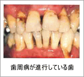 歯周病が進行している歯